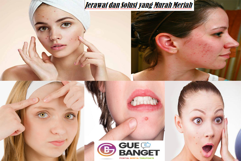 Takut Jerawat Bandel,OO,,,No â€¦Tidak Lagi