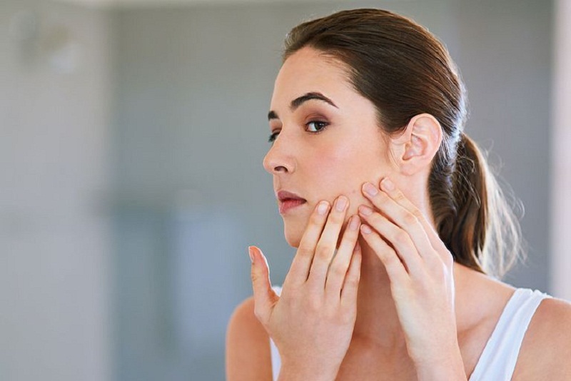 5 Cara Cegah Jerawat Berbekas Pada Wajah