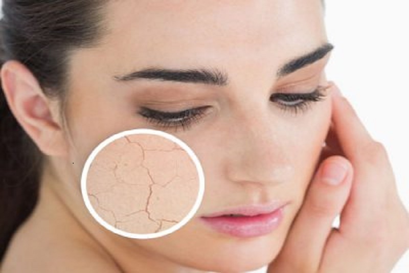 Tips Menghilangkan Jerawat Dengan Cara Alami