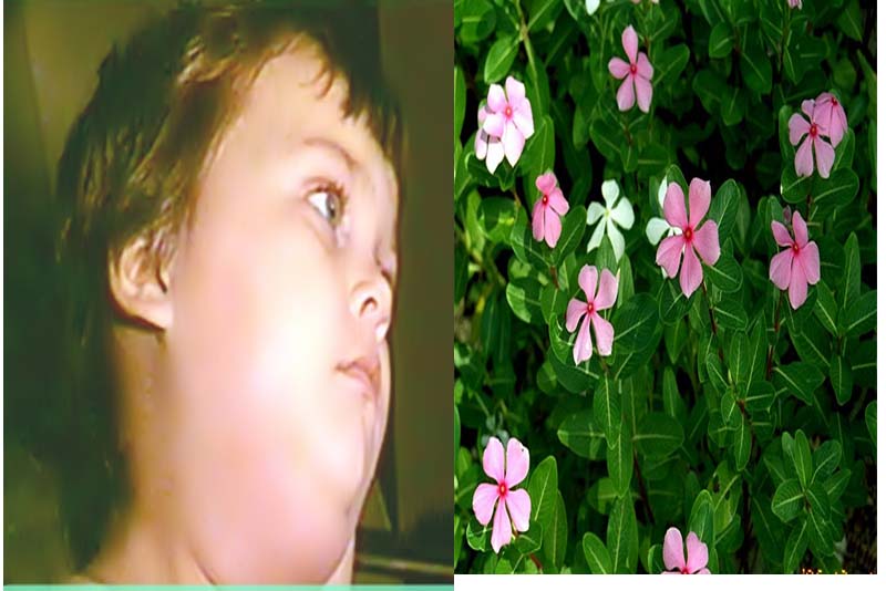 Kenyataan Penyakit Gondong yang Belakangan Sering Terjadi di Masyarakat 