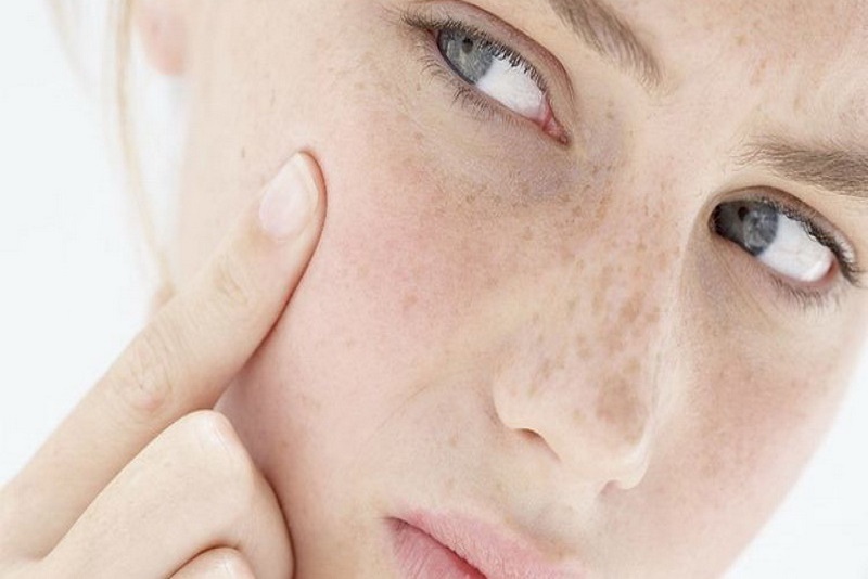 Tips Mengatasi Kulit Wajah  yang Kering