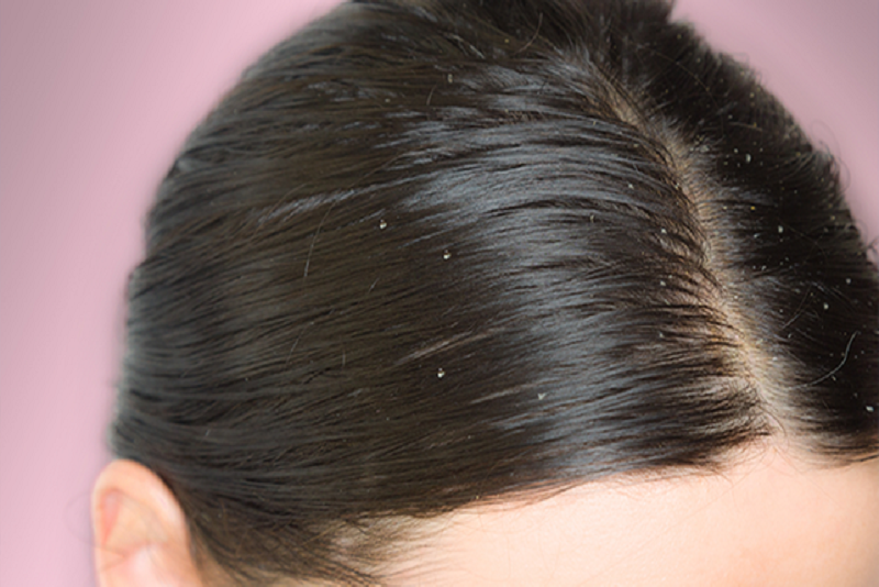 Ketahui Penyebab dan Cara Mengatasi Masalah Rambut Berketombe