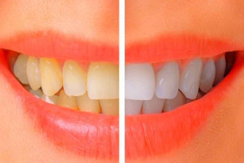 Trik Putihkan Gigi dengan Singkat dan Aman