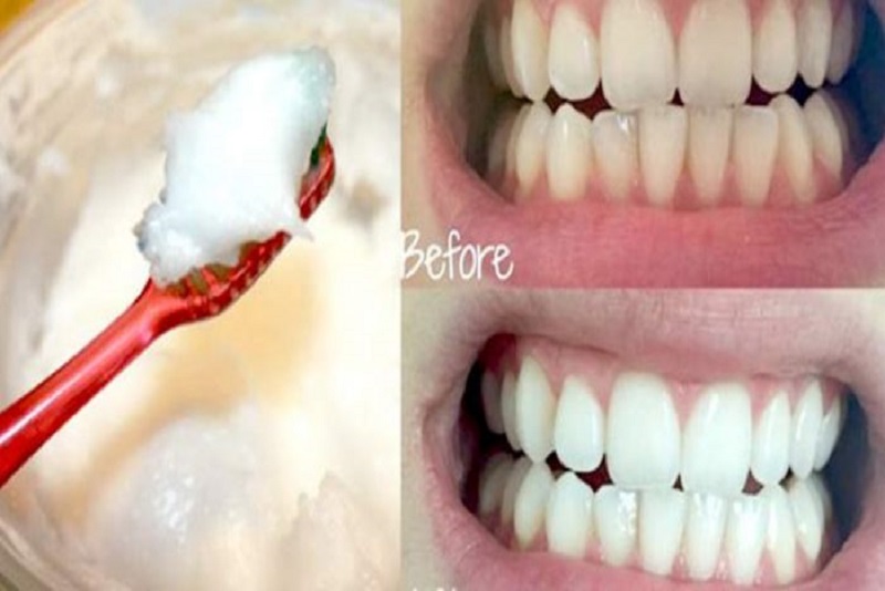 Ingin Gigi Putih? Ini 5 Cara Alami Bikin Gigi Putih